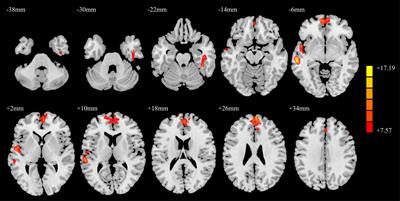 Aberrant gray matter volume and functional connectivity in Parkinson’s disease with minor hallucination